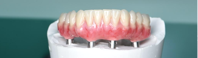 Полный зубной протез на имплантах