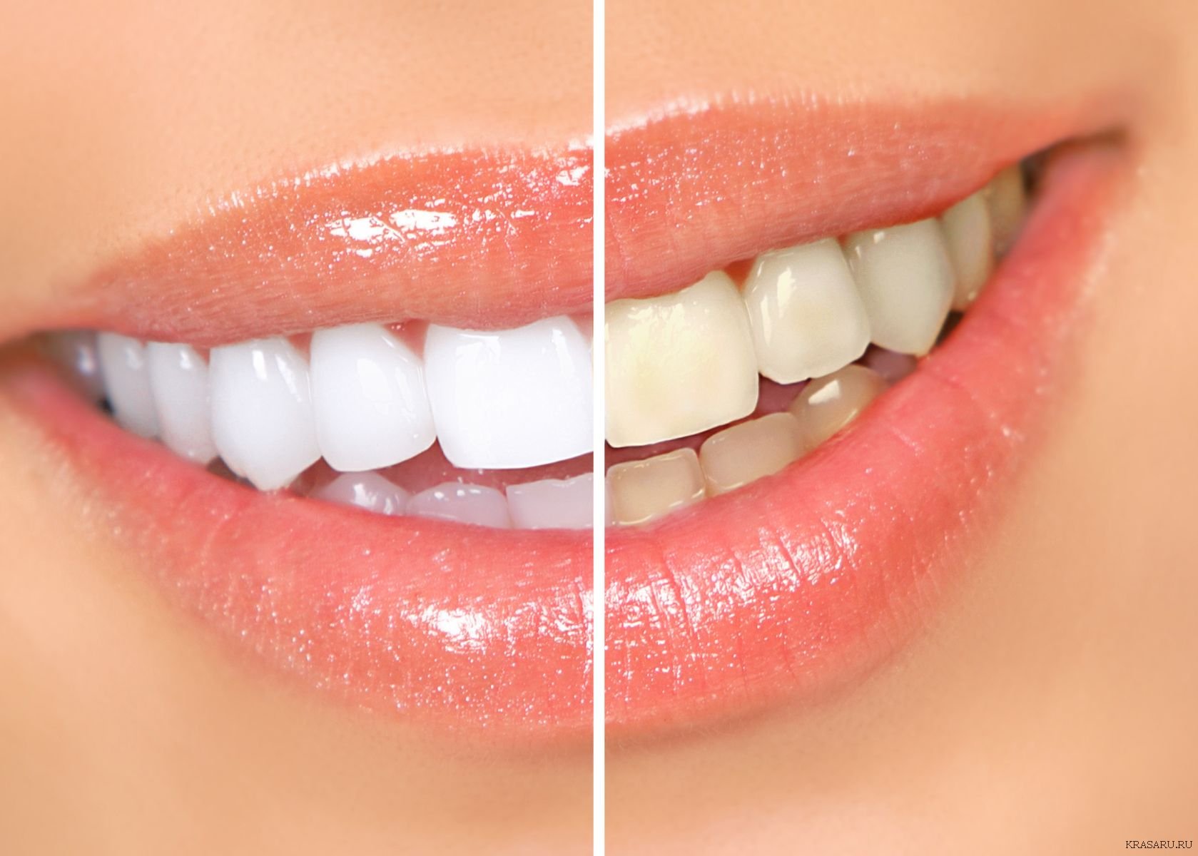 Зубы после и до отбеливания