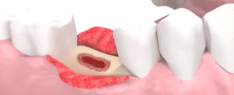 Бережное удаление зуба