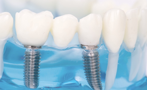Классическая имплантация зубов
