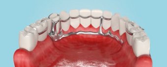 Бюгельный протез с шинирующими элементами при отсутствии нескольких зубов